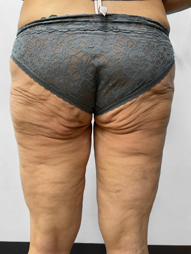 Before Image: Thigh Liposuction – Dr. Howell - back