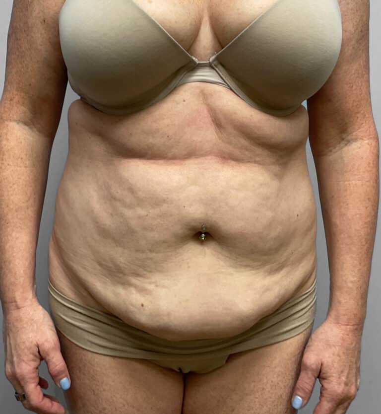 Before Image: Abdominoplasty & Lipo – Dr.Howell - front
