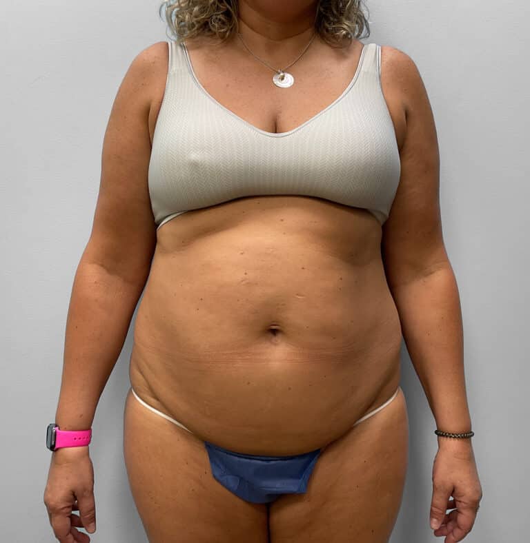 Before Image: Abdominoplasty & Liposuction – Dr. Tucker - front