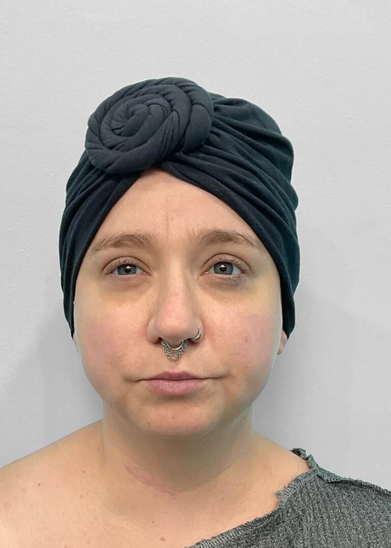 Before Image: Restylane Kysse – Joy - front
