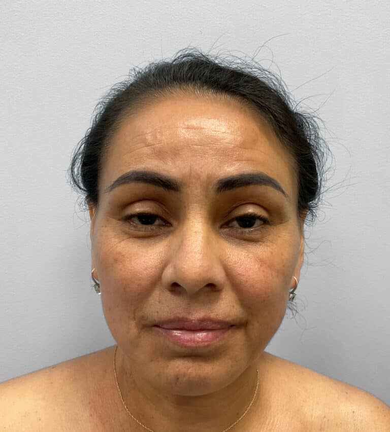Before Image: Upper and Lower Blepharoplasty – Dr. Tucker - front