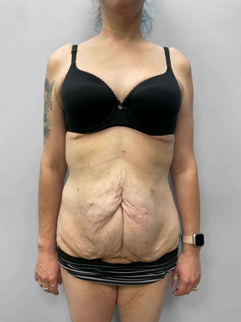 Before Image: Abdominoplasty & Liposuction – Dr. Howell - front