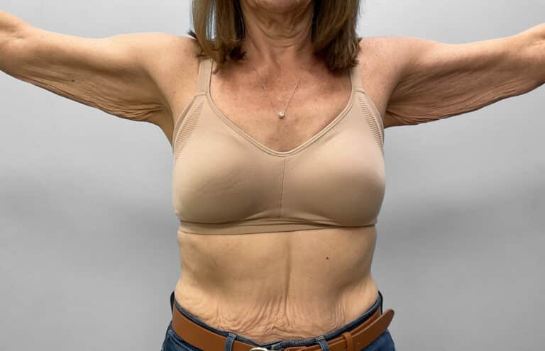 Before Image: Arm Lift – Dr. Howell - front