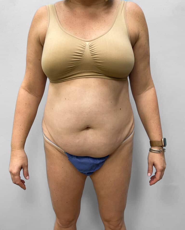 Before Image: Abdominoplasty & Liposuction – Dr. Tucker - front
