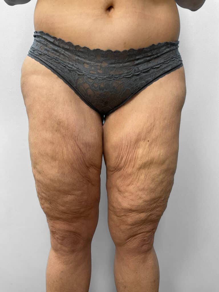 Before Image: Thigh Liposuction – Dr. Howell - front