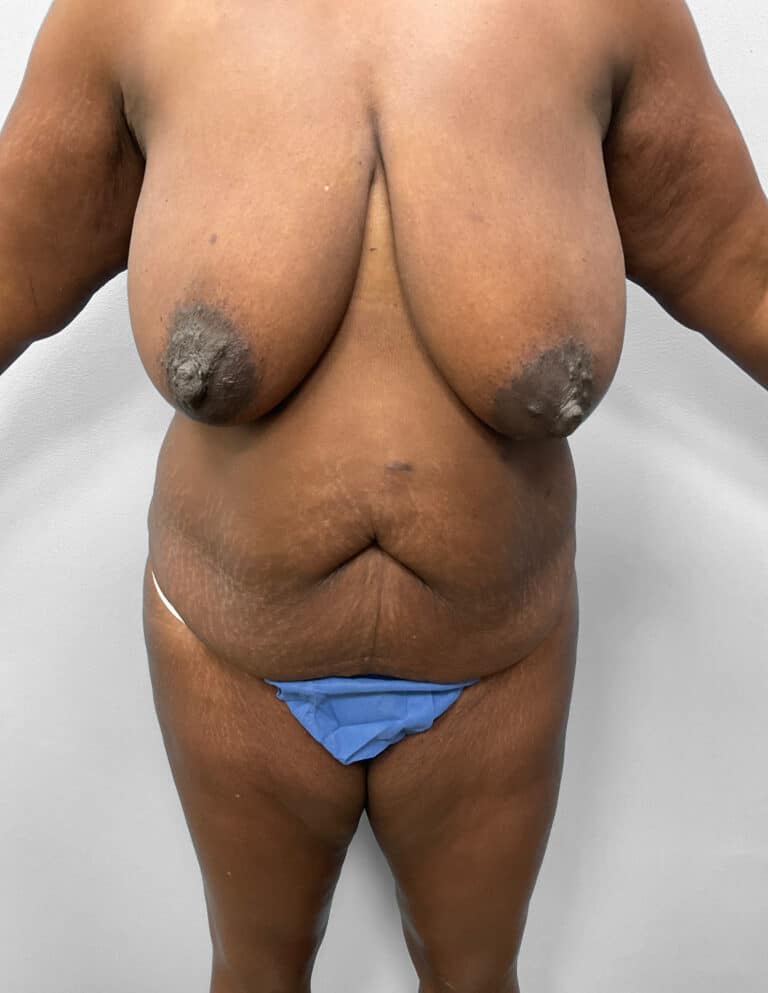 Before Image: Mommy Makeover – Dr. Tucker - front