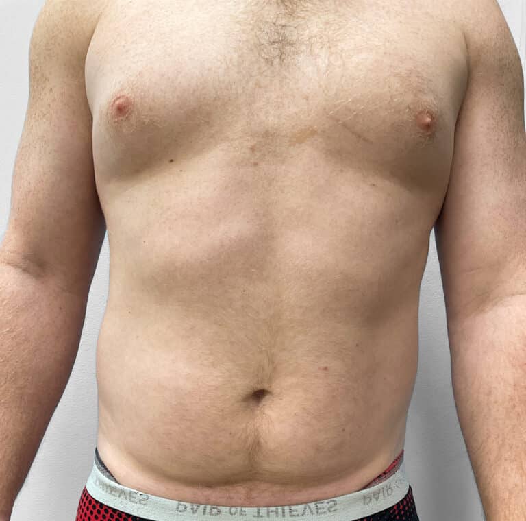 Before Image: Liposuction – Dr. Tucker - front