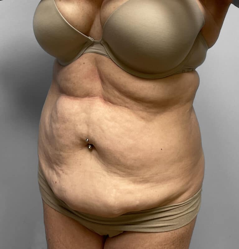 Before Image: Abdominoplasty & Lipo – Dr.Howell - left-front-oblique