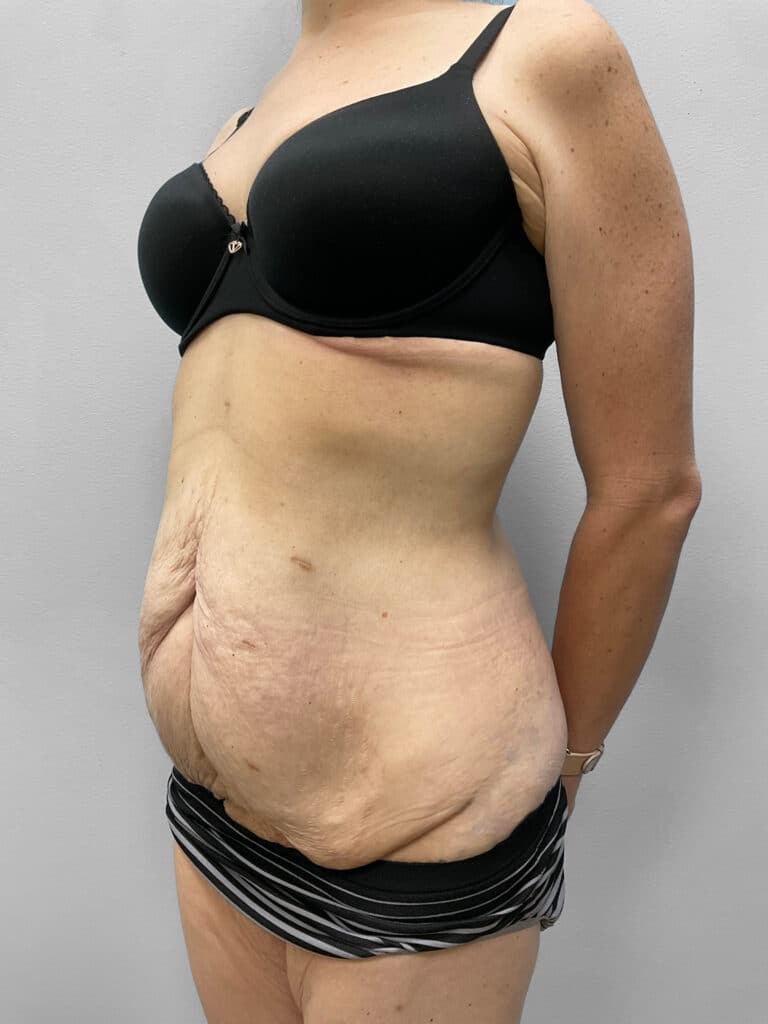 Before Image: Abdominoplasty & Liposuction – Dr. Howell - left-front-oblique