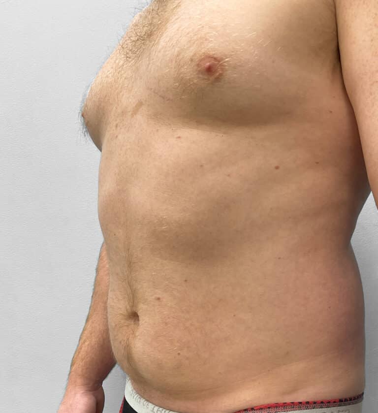 Before Image: Liposuction – Dr. Tucker - left-front-oblique