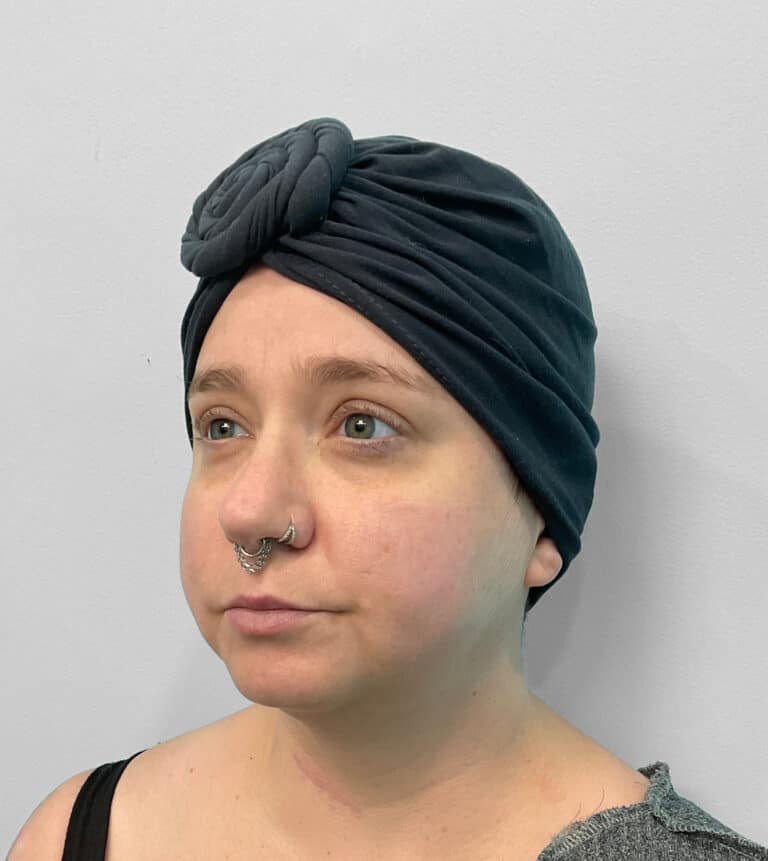 Before Image: Restylane Kysse – Joy - left-front-oblique