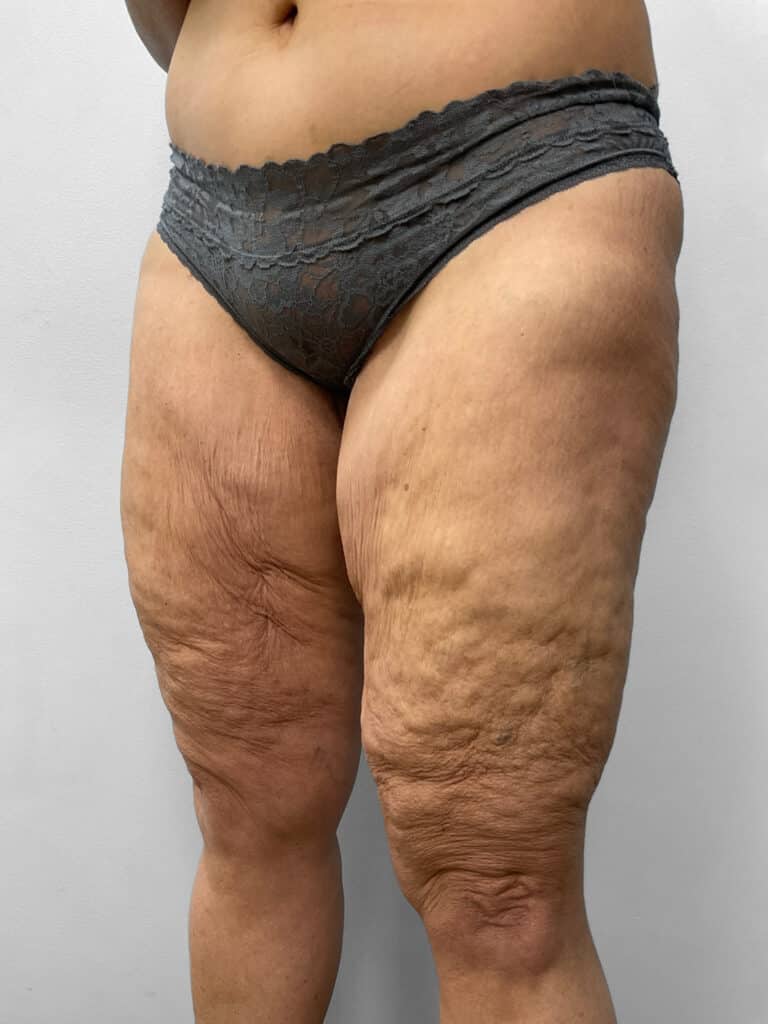 Before Image: Thigh Liposuction – Dr. Howell - left-front-oblique