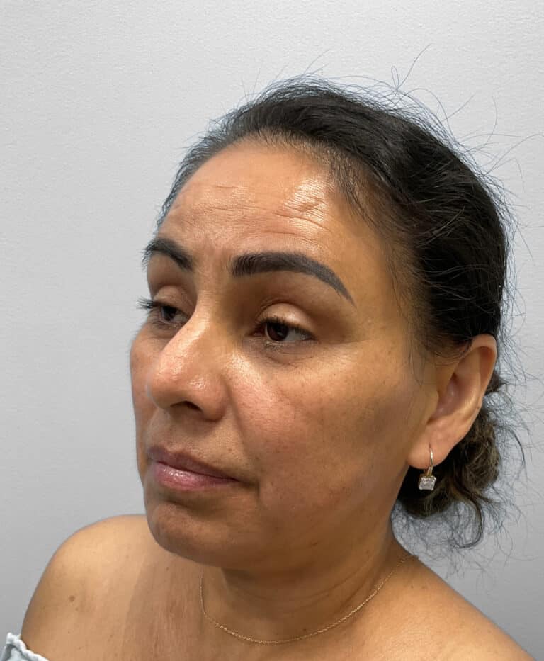 Before Image: Upper and Lower Blepharoplasty – Dr. Tucker - left-front-oblique