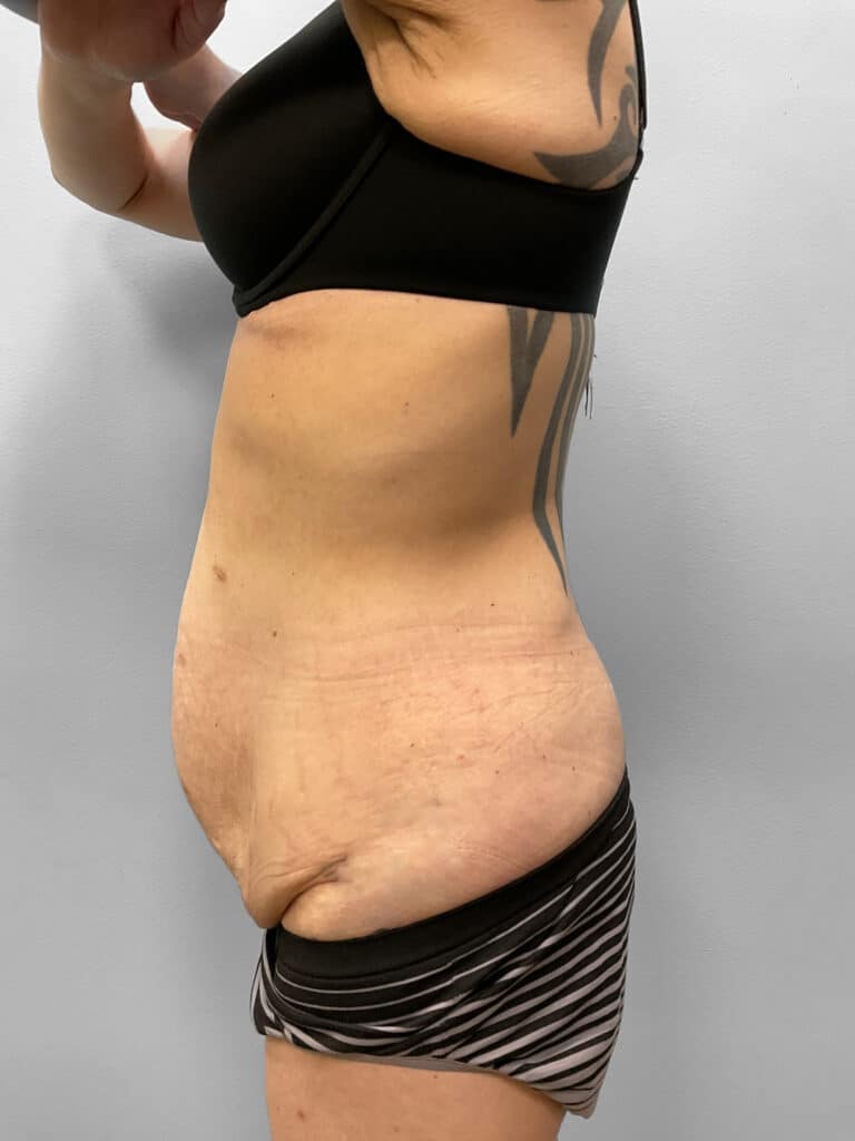 Before Image: Abdominoplasty & Liposuction – Dr. Howell - left-side