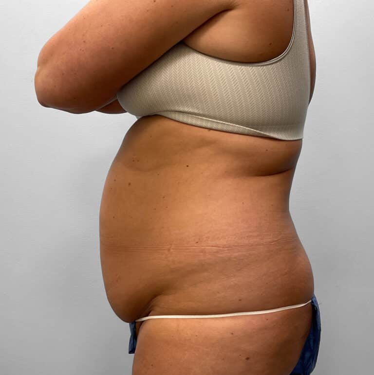 Before Image: Abdominoplasty & Liposuction – Dr. Tucker - left-side