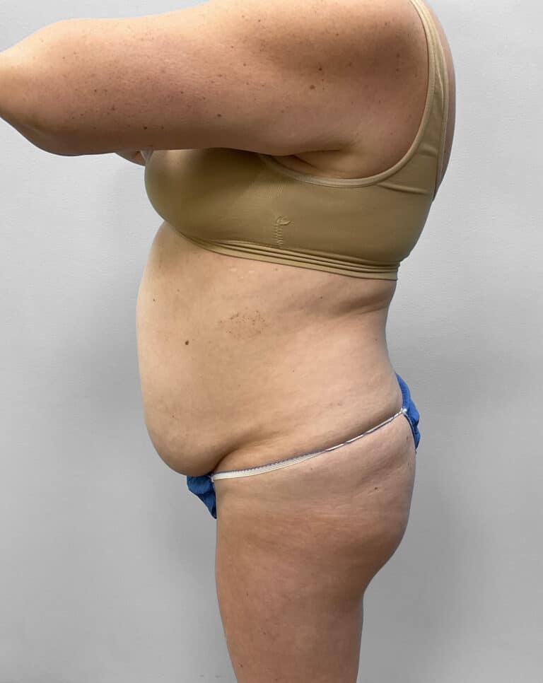 Before Image: Abdominoplasty & Liposuction – Dr. Tucker - left-side