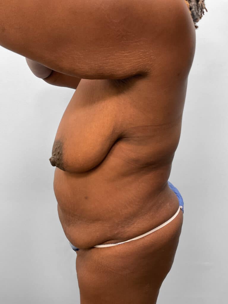Before Image: Mommy Makeover – Dr. Tucker - left-side
