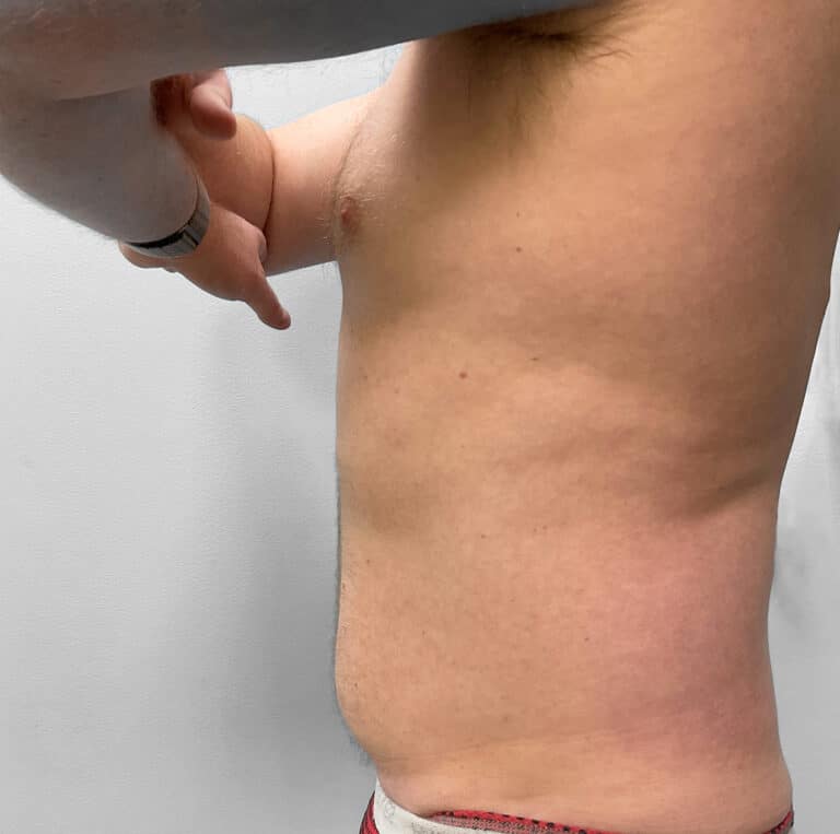 Before Image: Liposuction – Dr. Tucker - left-side