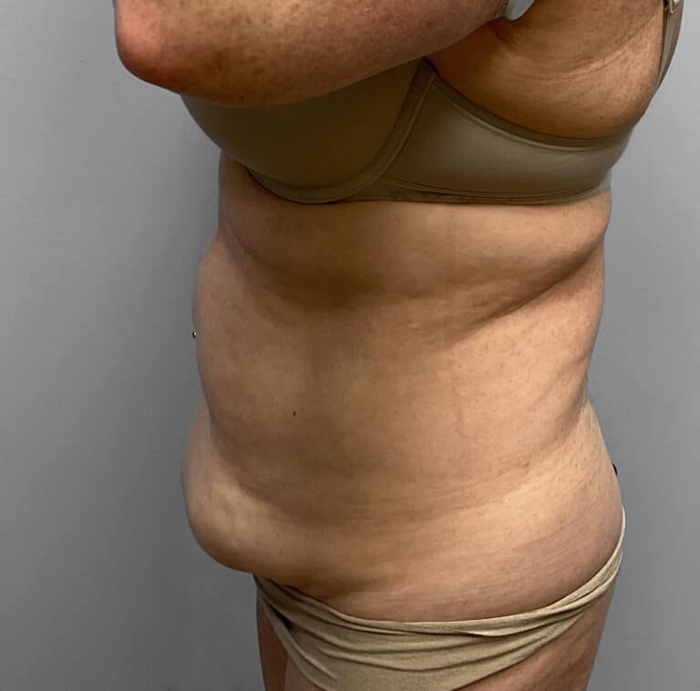 Before Image: Abdominoplasty & Lipo – Dr.Howell - left-side