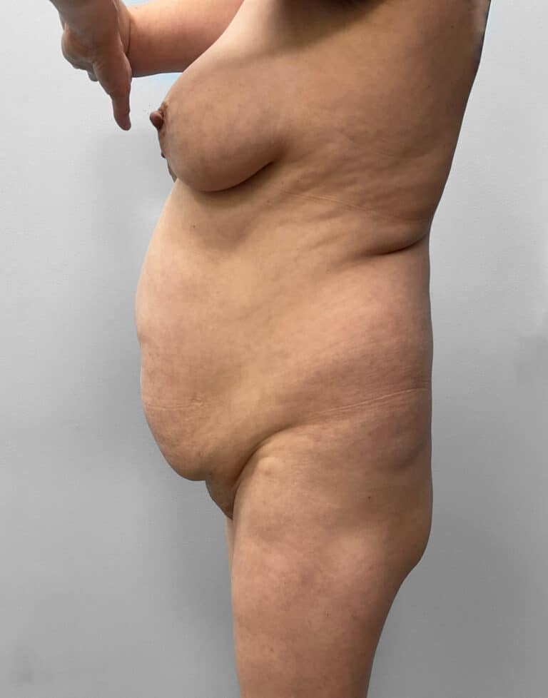 Before Image: Tummy Tuck, Lipo, & BBL – Dr. Tucker - left-side