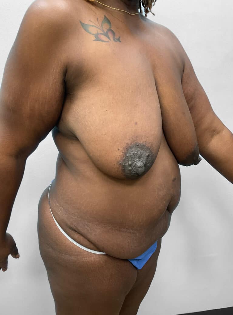 Before Image: Mommy Makeover – Dr. Tucker - right-front-oblique