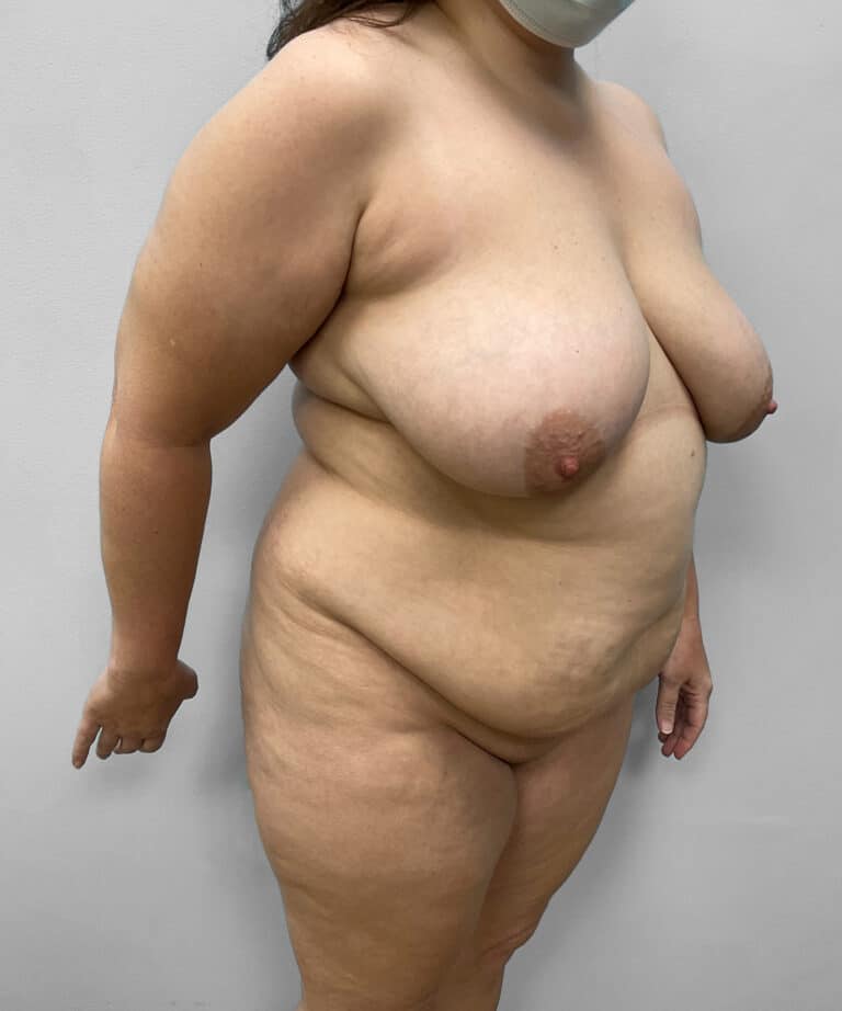 Before Image: Tummy Tuck, Lipo, & BBL – Dr. Tucker - right-front-oblique