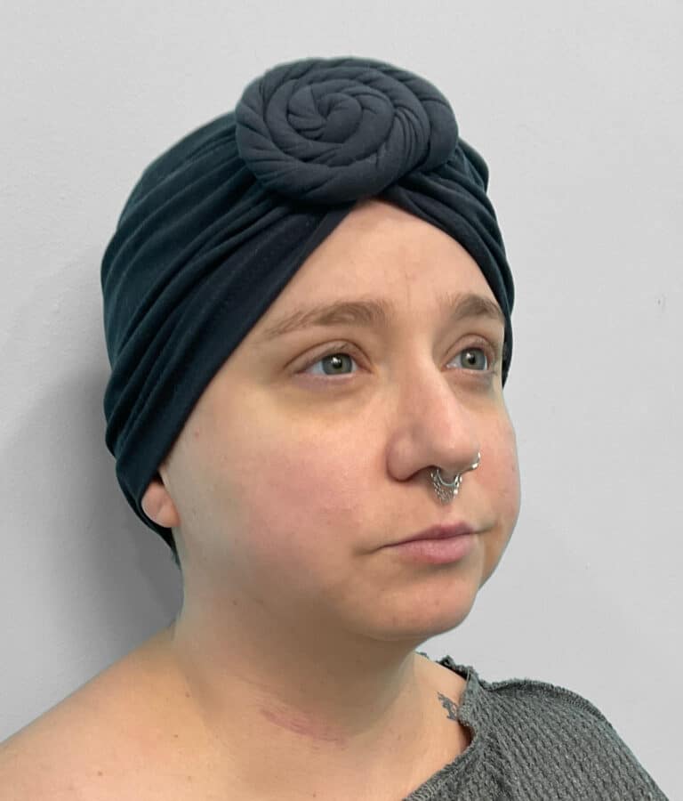 Before Image: Restylane Kysse – Joy - right-front-oblique