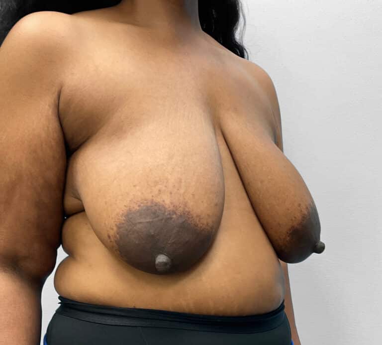 Before Image: Breast & Arm Lift with Liposuction – Dr. Howell - right-front-oblique