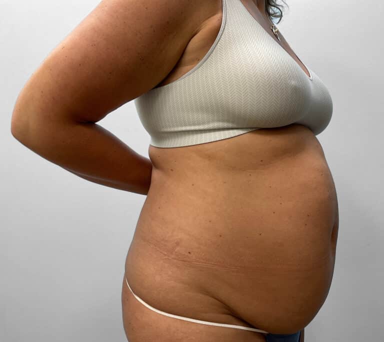 Before Image: Abdominoplasty & Liposuction – Dr. Tucker - right-front-oblique
