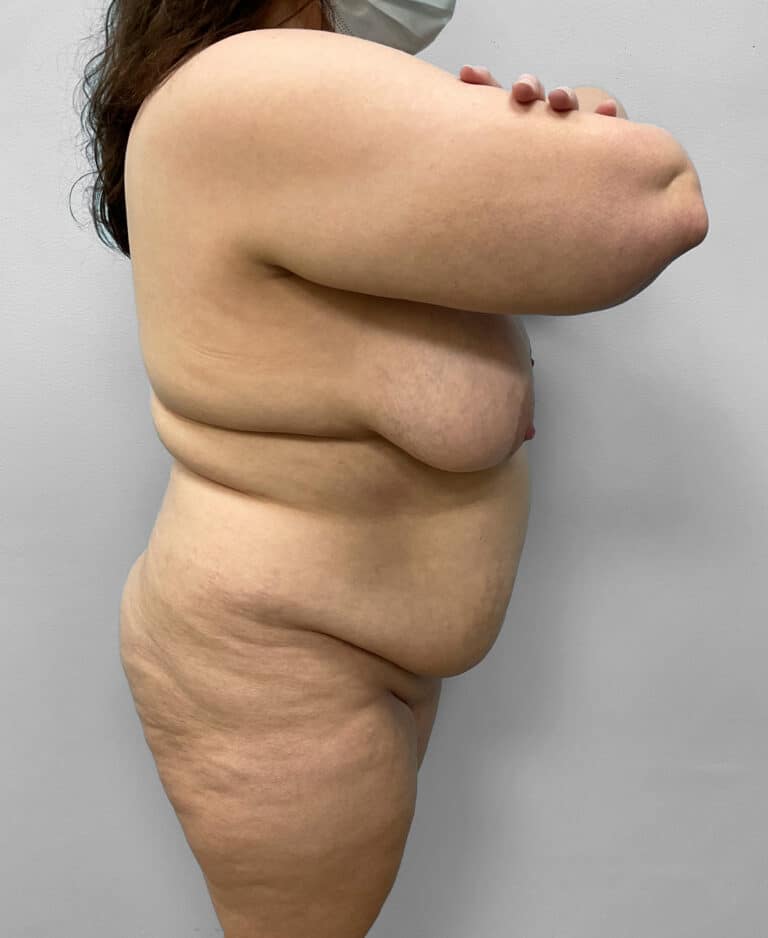 Before Image: Tummy Tuck, Lipo, & BBL – Dr. Tucker - right-side