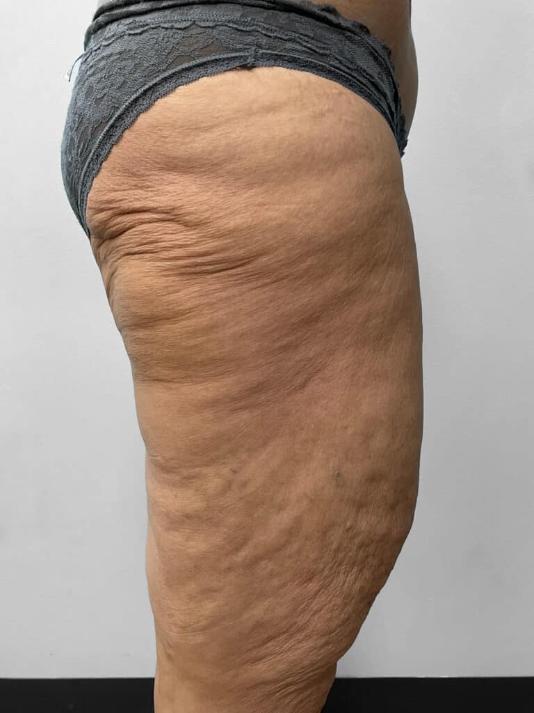 Before Image: Thigh Liposuction – Dr. Howell - right-side