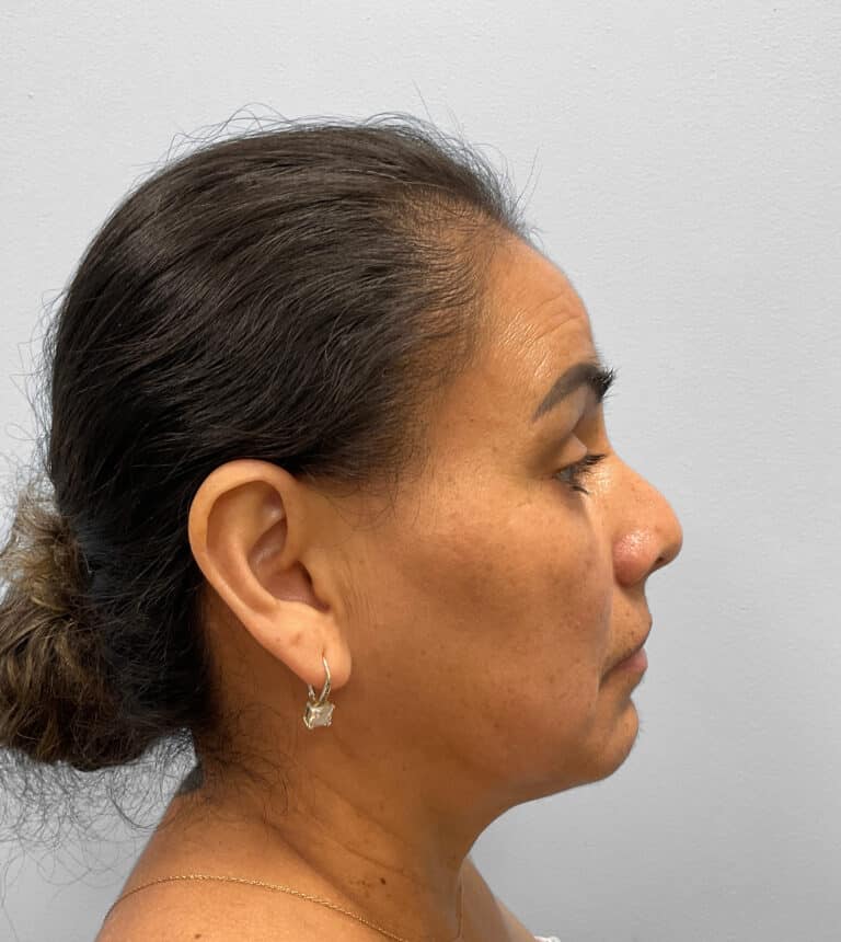 Before Image: Upper and Lower Blepharoplasty – Dr. Tucker - right-side