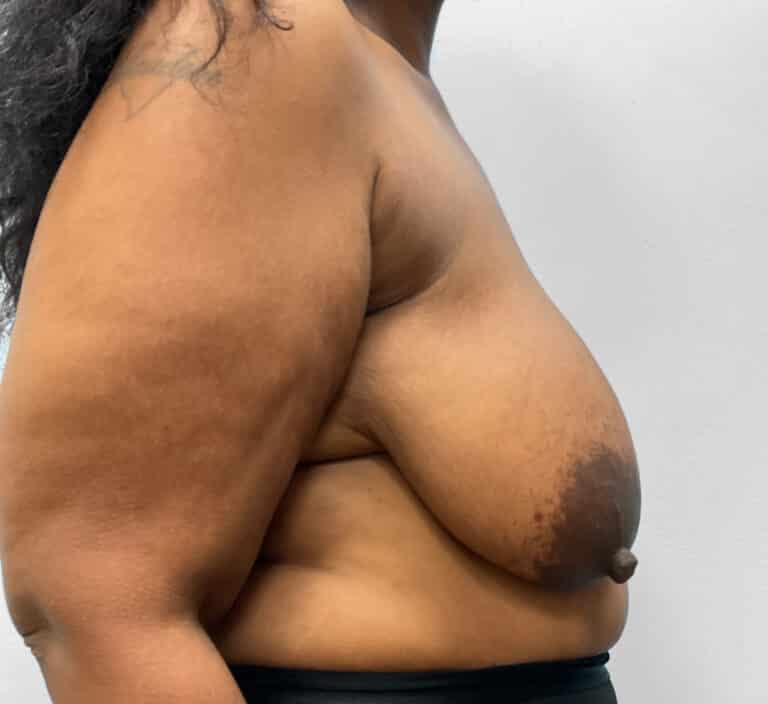 Before Image: Breast & Arm Lift with Liposuction – Dr. Howell - right-side