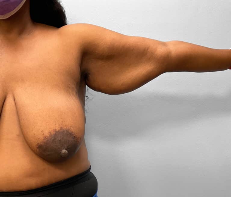 Before Image: Breast & Arm Lift with Liposuction – Dr. Howell - right-side