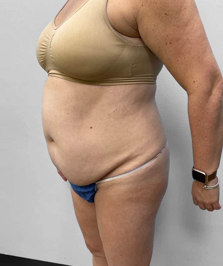 Before Image: Abdominoplasty & Liposuction – Dr. Tucker - left-front-oblique