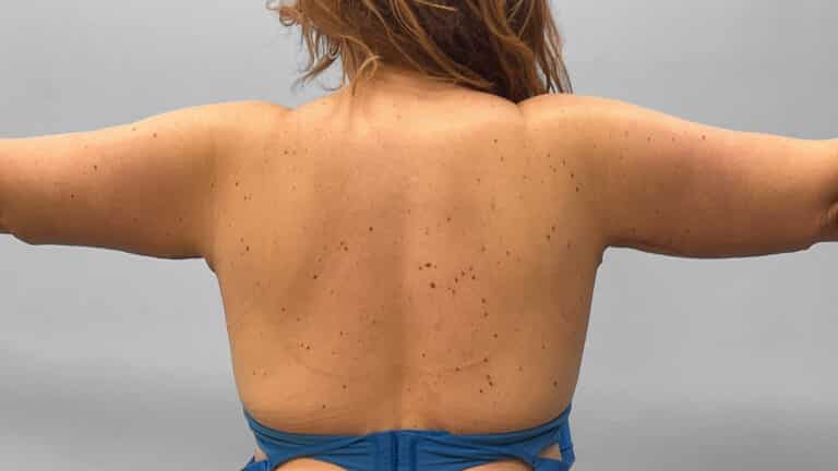 After Image: Arm Lift- Dr. Tucker - back