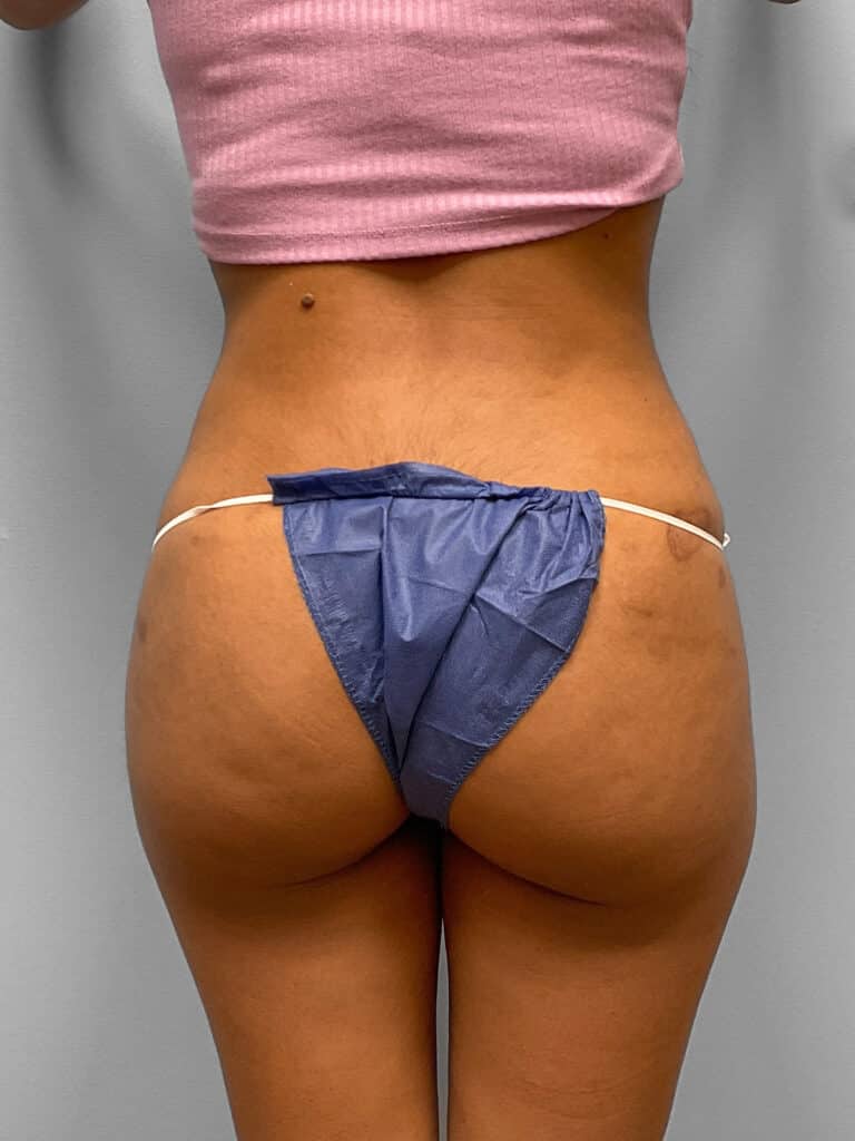 After Image: Tummy Tuck, Lipo, & BBL- Dr. Tucker -