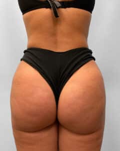 After Image: BBL & Liposuction- Dr. Howell
