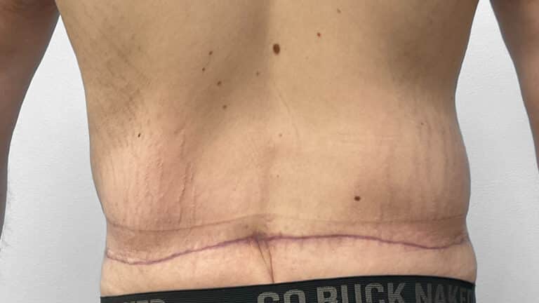 After Image: Body Lift- Dr. Tucker - back