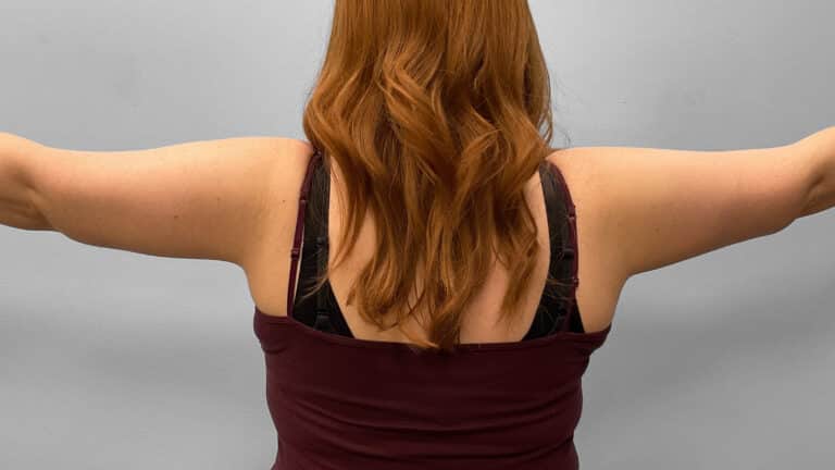After Image: Arm Lift- Dr. Tucker - front