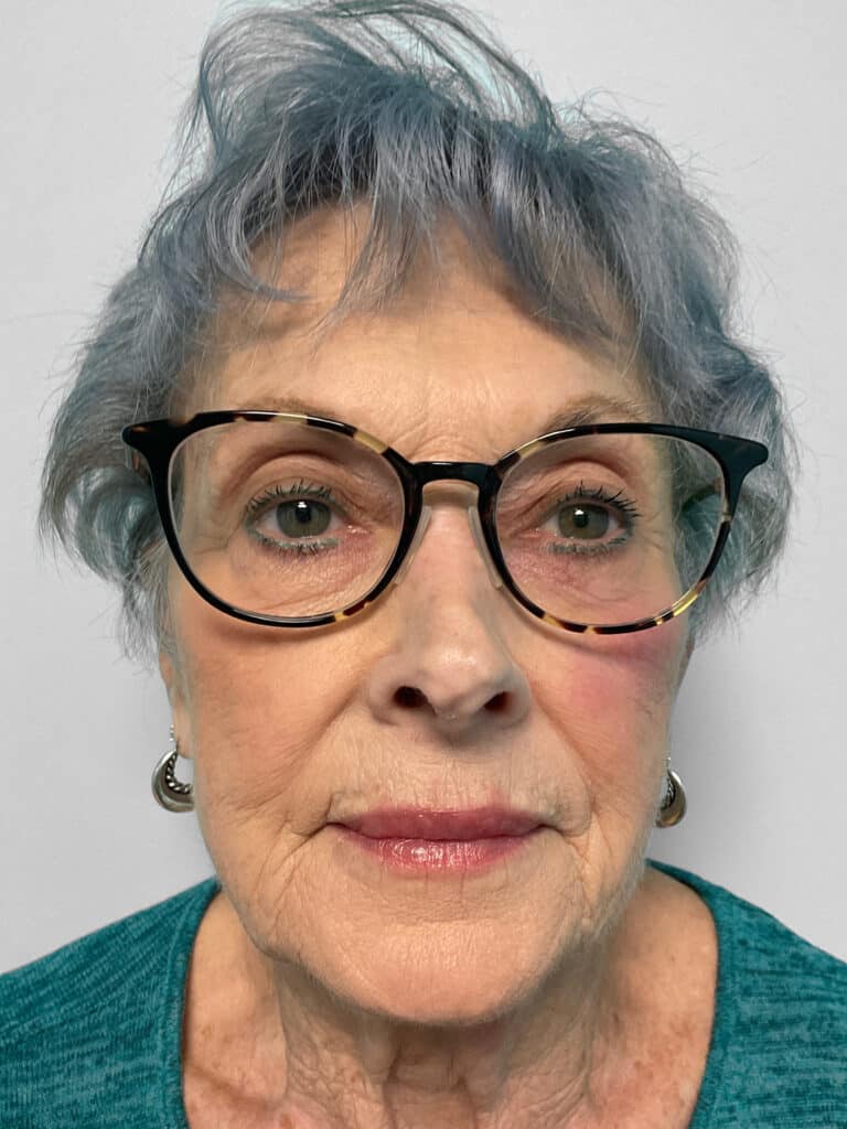 After Image: Botox & Restylane Kysse- Heather - front