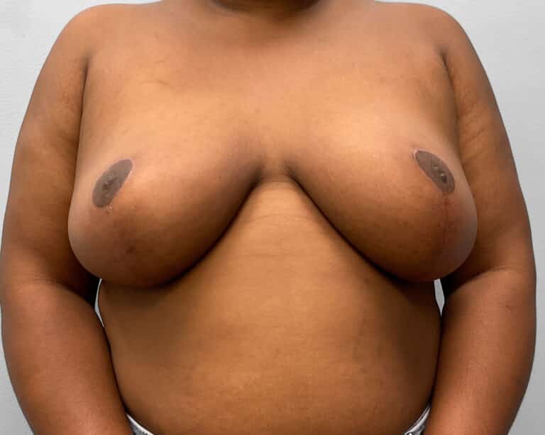 After Image: Breast Reduction- Dr. Tucker - front