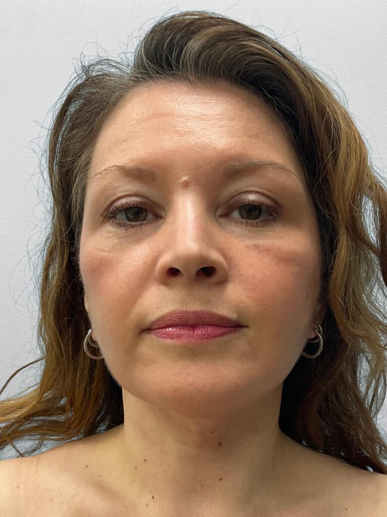 After Image: Facelift- Dr. Tucker - front