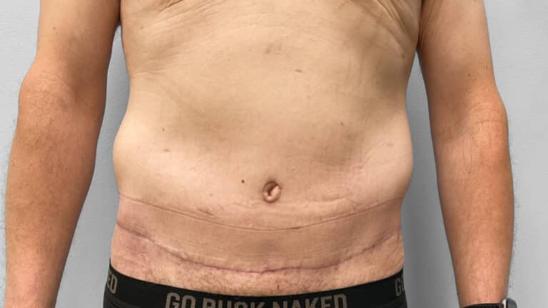 After Image: Body Lift- Dr. Tucker - front
