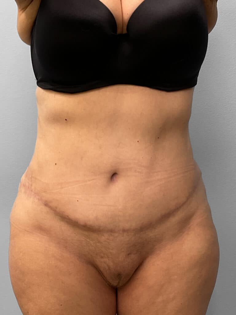 After Image: Tummy Tuck & Liposuction- Dr. Tucker - front