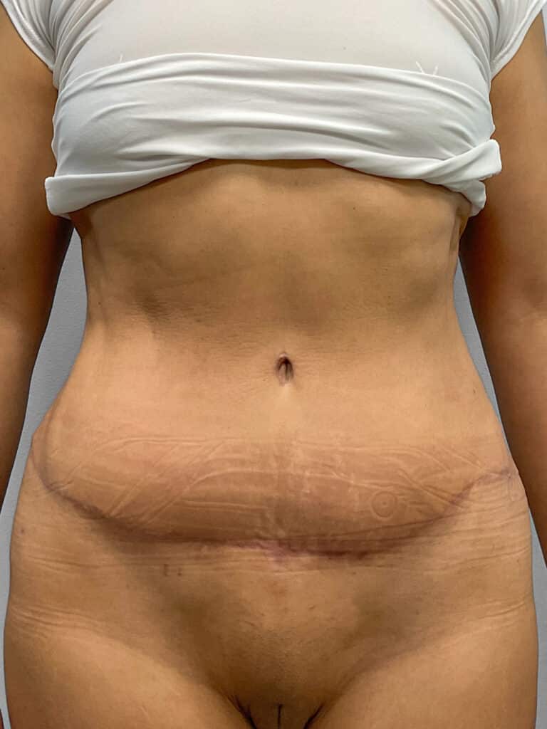 After Image: Abdominoplasty & Lipo- Dr. Tucker - front