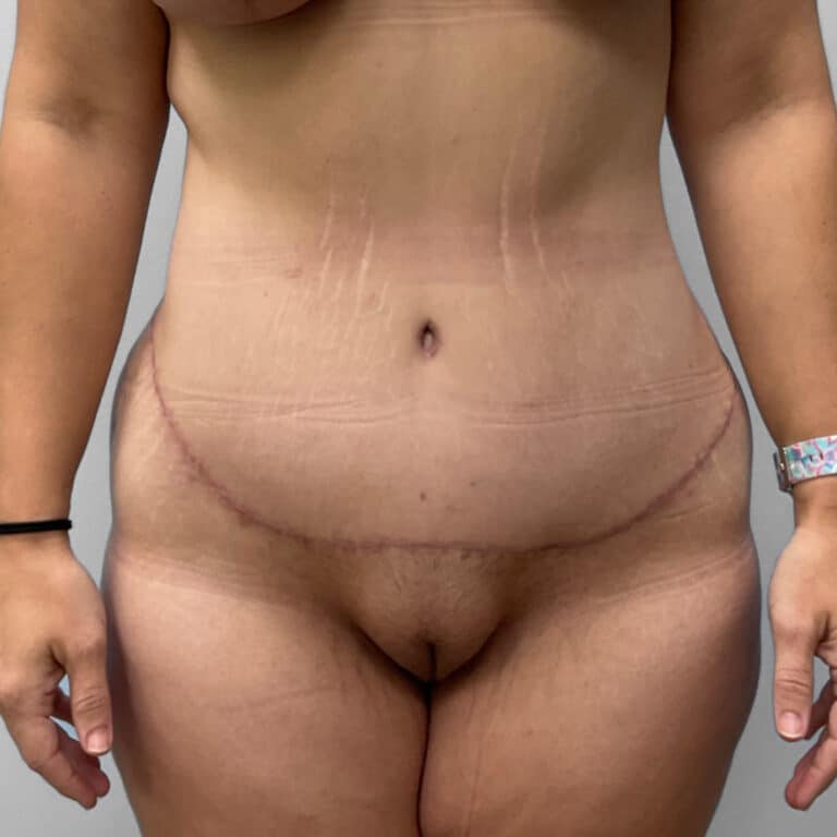 After Image: Tummy Tuck & Lipo- Dr. Howell - front