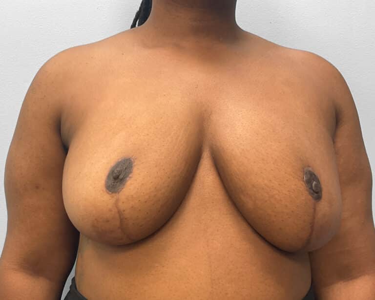 After Image: Breast Reduction- Dr. Tucker - front