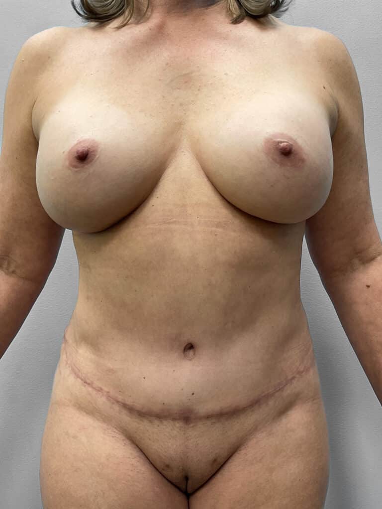 After Image: Abdominoplasty and Lipo- Dr. Tucker - front