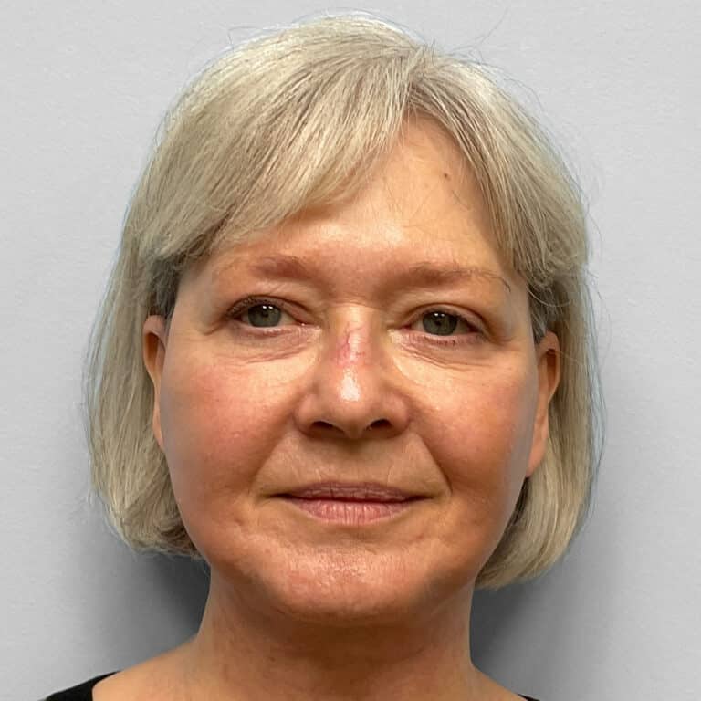 After Image: Facelift & TFX- Dr. Tucker - front